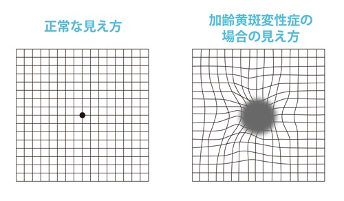 加齢黄斑変性の説明画像