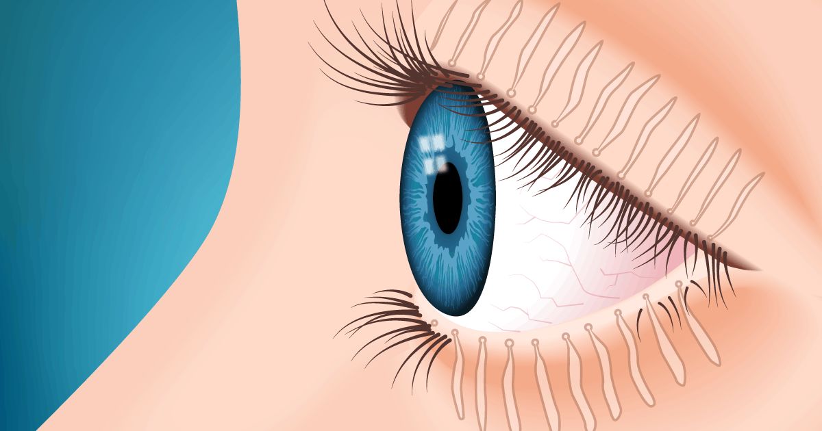 Meibomian Gland Dysfunction - All About Vision
